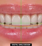 שיקום חניכיים - תמונת אווירה